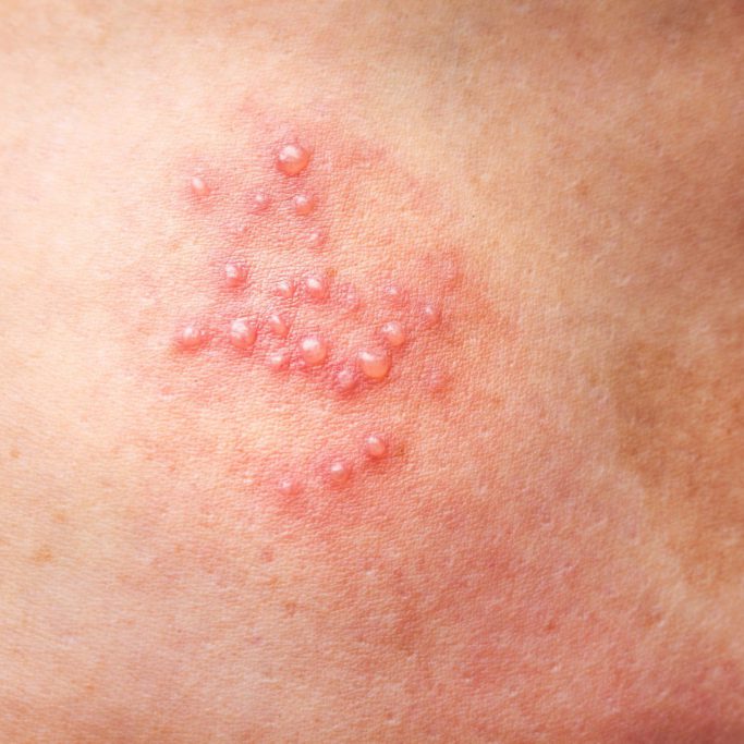 Gordelroos Ontstaan En Behandeling Fagron Derma Gordelroos Ontstaan En Behandeling Fagron Derma
