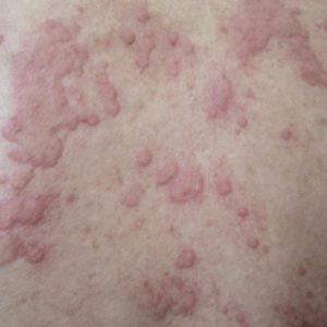 Afbeelding van huid met netelroos (ook bekend als urticaria)