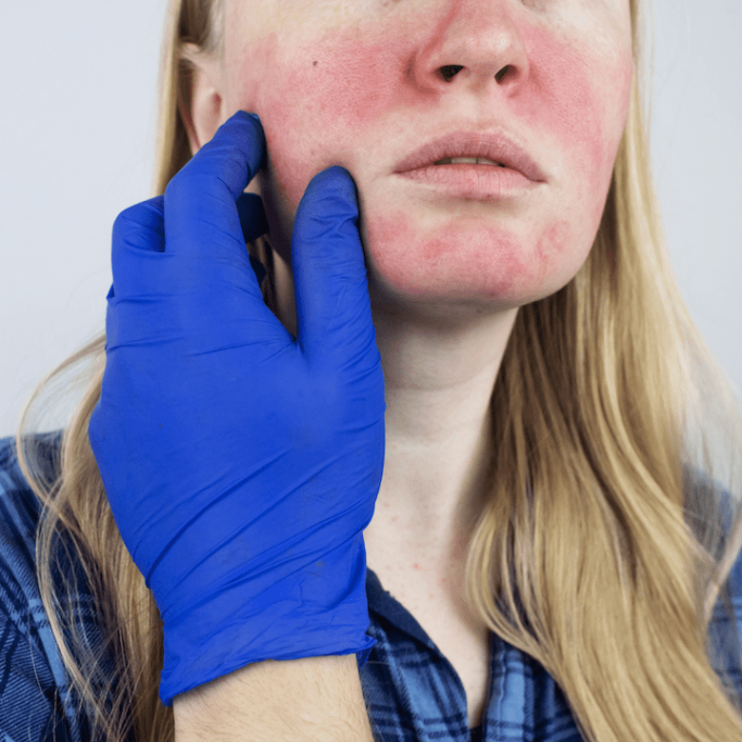 Rosacea behandeling