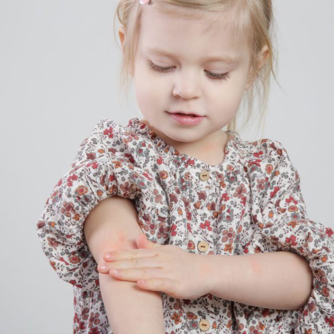 Eczeem bij kinderen