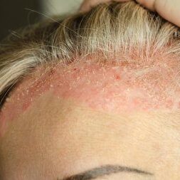 psoriasis hoofdhuid