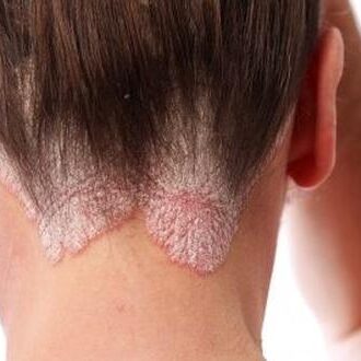 shampoo voor psoriasis op de hoofdhuid
