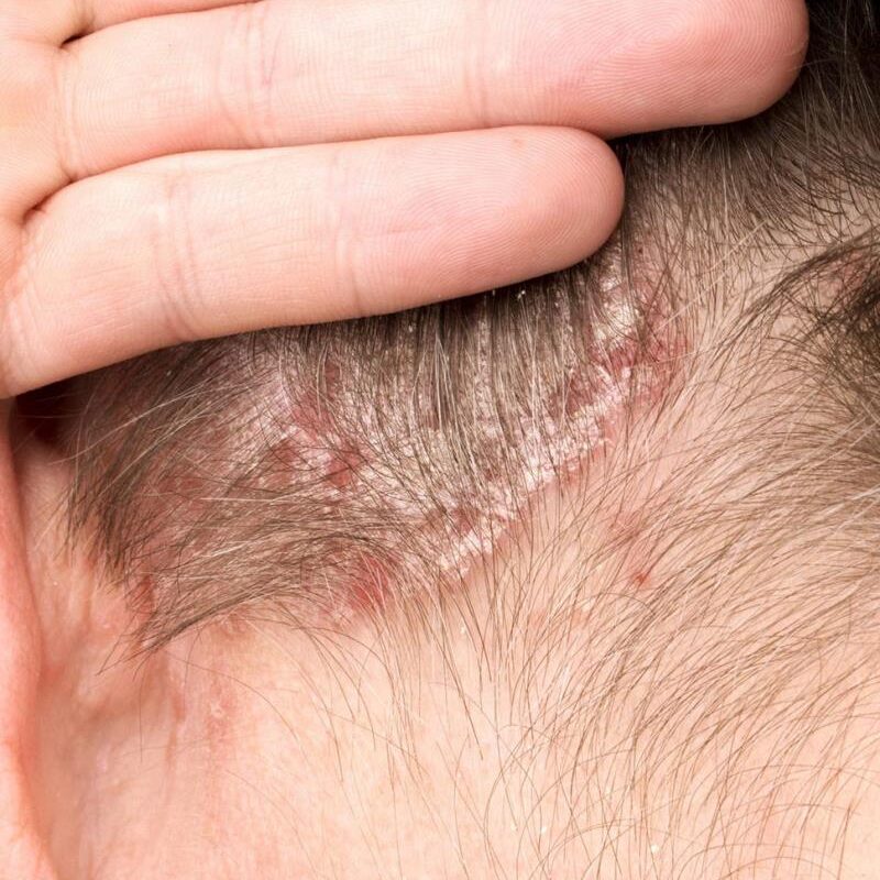 psoriasis hoofdhuid