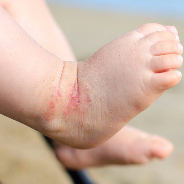baby met eczeem op de huid